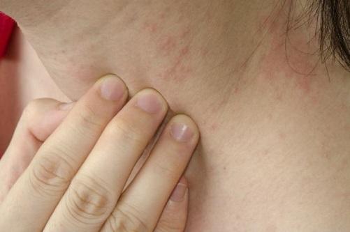 Псориаз — не заболевание кожи!