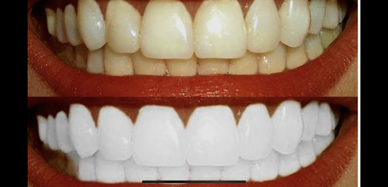 Ինչպես տնային պայմաններում սպիտակեցնել ատամները. Շատ պարզ և մատչելի տարբերակ
