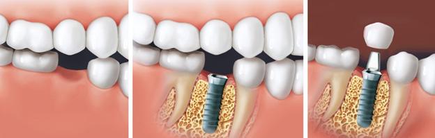 Սենսացիոն բացահայտում ինչպես աճեցնել նոր ատամներ ընդամենը 9 շաբաթում