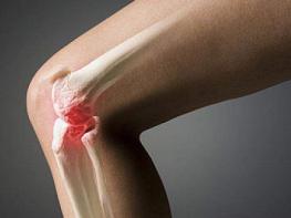 Лечение деформирующего артроза коленного сустава народными средствами