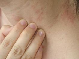 Псориаз — не заболевание кожи!