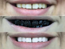 Տան պայմաններում սպիտակեցրեք ձեր ատամները և ունեցեք ամենագեղեցիկ ատամնաշարն ու ժպիտը